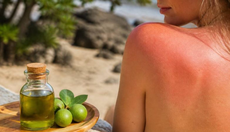 Huile de tamanu et coup de soleil : peut-elle apaiser une brûlure ?