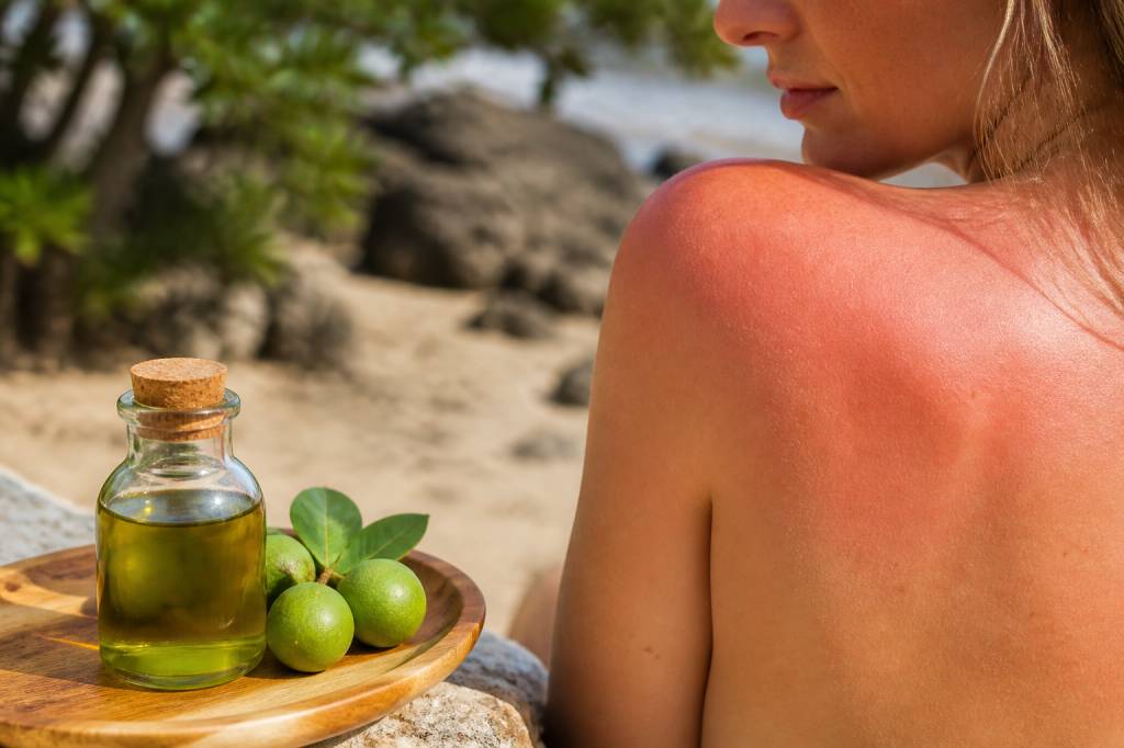 Huile de tamanu et coup de soleil : peut-elle apaiser une brûlure ?